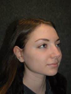 Rhinoplasty - Patient - Obl Right - Before