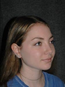 Rhinoplasty - Patient - Obl Right - After