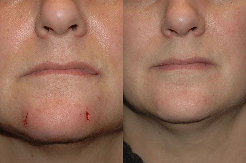 Example of a Dog Bite Scar Repair Before and After Photo Dog Bite Scar Repair Before and After