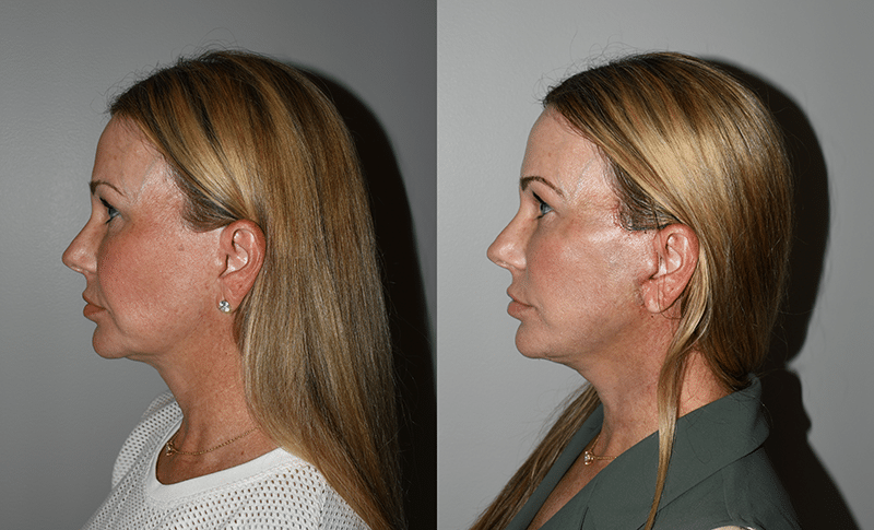 Before and After Deep Plane Facelift Revision Results