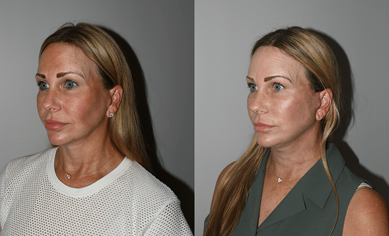 Before and After Deep Plane Facelift Revision Results